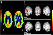 Correlation study of quantitative and qualitative analysis results in PET/CT imaging of temporal lobe epilepsy patients in Iran